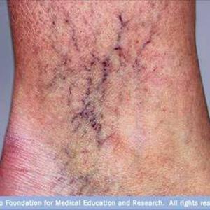 Varicose Veins Pics - More Quack Cures For Varicose Veins