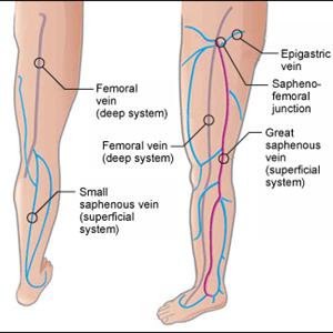 Varicose Veins Overview - Tart Cherry Juice Helps Fight Varicose Veins