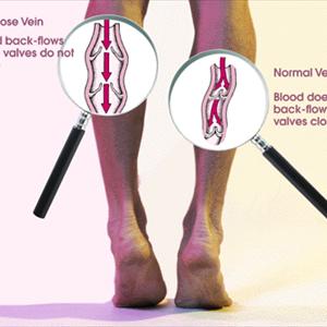 Spider Vein Clinics - A Review Of Laser Treatment For Varicose Veins