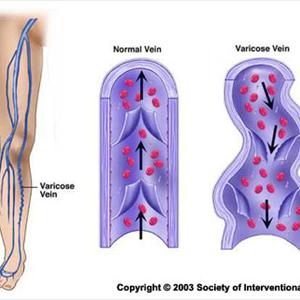 Vulvar Varicosities Movies - Discussion Of Varicose Veins And FAQ