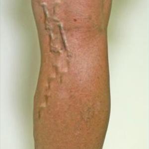 Varicose Veins Ayurveda - Diagnosing Varicose Veins And Other Venous Disorders