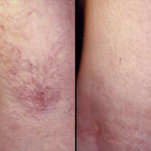 Varicose Veins Signs - Restylane Lips, Restylane Fillers And Varicose Veins