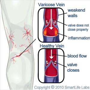 Deep Varicose Veins - Restylane Lips, Restylane Fillers And Varicose Veins