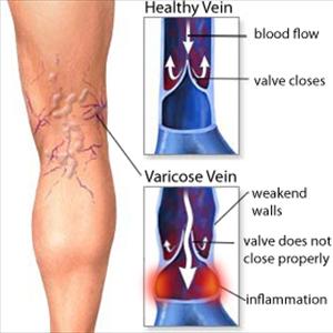 Varicose Vein Rejuvenation - Natural Supplements And Vitamins For Varicose Veins