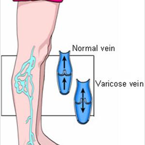 Varicose Veins - Questions To Ask Before Your Vein Treatment