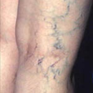 Aneurysm Varicose - Restylane Lips, Restylane Fillers And Varicose Veins