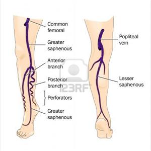 Primary Varicose Veins - Sclerotherapy To Eliminate Spider And Varicose Veins