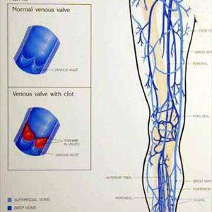Hypertension Varicose Veins - Varicose Veins More That A Cosmetic Concern