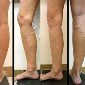 Varicose Socks - Psychological Impacts Of Spider Veins